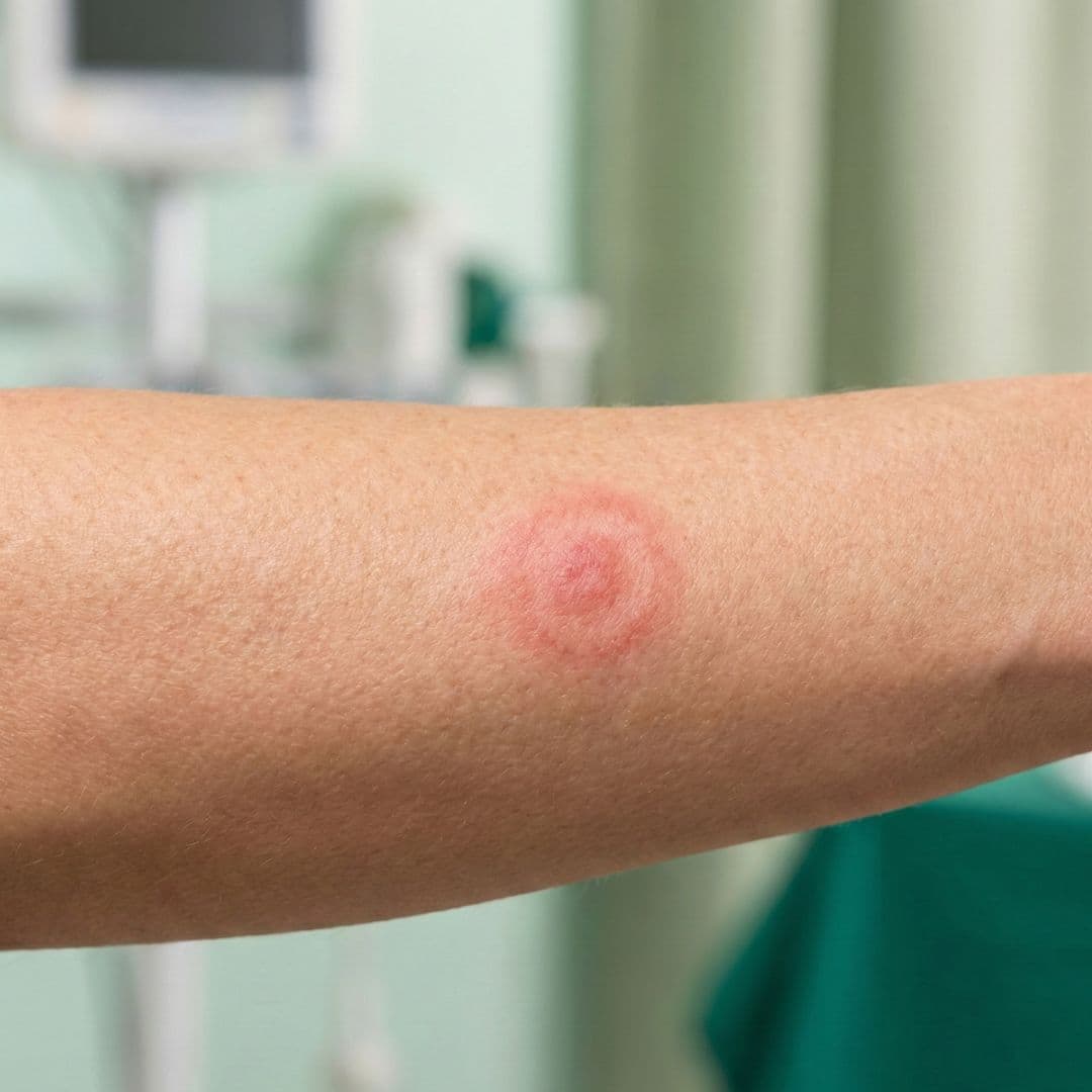 Borrelia – symtom – Närbild av underarm med rund, röd ringformad hudförändring med ljusare mitt och omgivande hud är jämn.