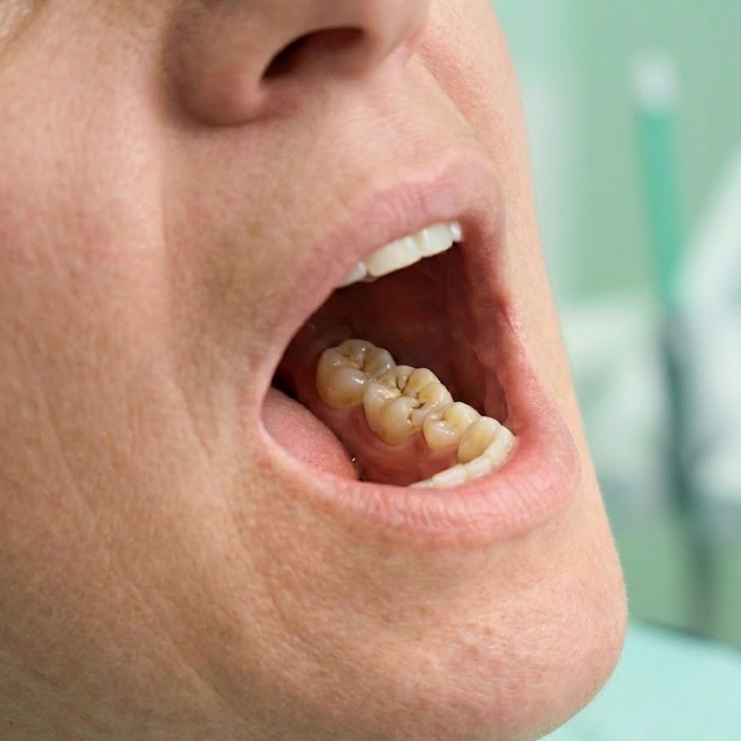  Hål i tanden – symtom – Närbild av öppen mun: en kindtand med liten brun‑svart grop på tuggytan; omgivande tandkött är rosa. Bild genererad av AI