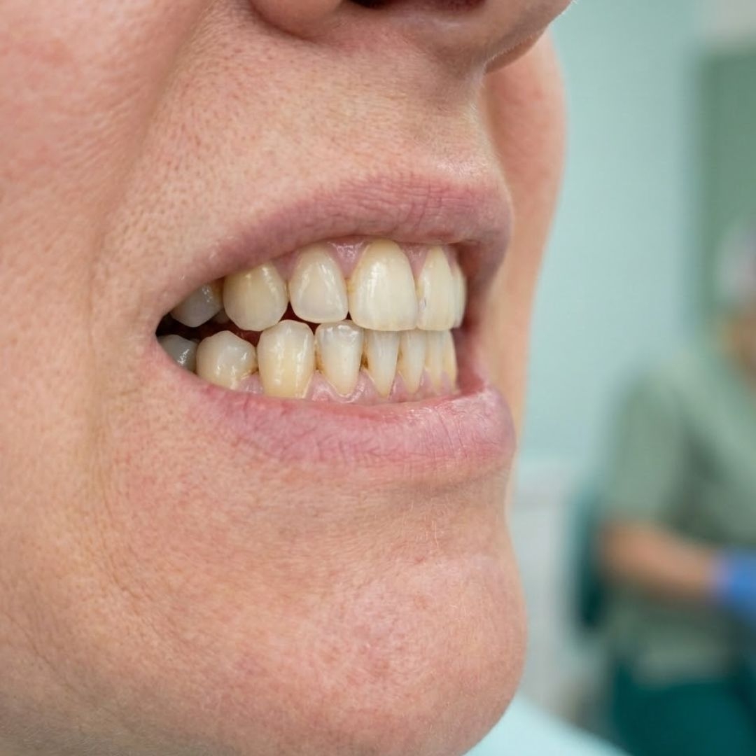 Tartar (dental calculus) symptoms – yellowish, hard deposits at the gumline; multiple patches and an uneven surface, illustrative image. Image generated by AI