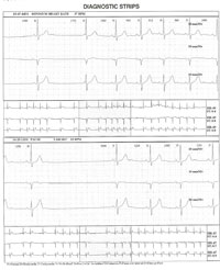 EKG:n pitkäaikaisrekisteröinnissä seurataan sydämen rytmiä vuorokauden ajan.